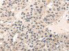The image on the left is immunohistochemistry of paraffin-embedded Human breast cancer tissue using CSB-PA922141 (MED28 Antibody) at dilution 1/30, on the right is treated with fusion protein. (Original magnification: ×200) The image on the left is immunohistochemistry of paraffin-embedded Human breast cancer tissue using CSB-PA922141 (MED28 Antibody) at dilution 1/30, on the right is treated with fusion protein. (Original magnification: ×200)