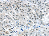 The image on the left is immunohistochemistry of paraffin-embedded Human breast cancer tissue using CSB-PA219965 (MED4 Antibody) at dilution 1/25, on the right is treated with fusion protein. (Original magnification: ×200)