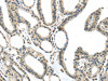 The image on the left is immunohistochemistry of paraffin-embedded Human thyroid cancer tissue using CSB-PA995695 (MED18 Antibody) at dilution 1/30, on the right is treated with fusion protein. (Original magnification: ×200)