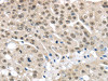 The image on the left is immunohistochemistry of paraffin-embedded Human breast cancer tissue using CSB-PA179506 (MED15 Antibody) at dilution 1/30, on the right is treated with fusion protein. (Original magnification: ×200)