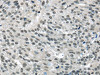 The image on the left is immunohistochemistry of paraffin-embedded Human breast cancer tissue using CSB-PA087753 (MED15 Antibody) at dilution 1/20, on the right is treated with fusion protein. (Original magnification: ×200)