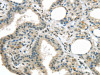 The image on the left is immunohistochemistry of paraffin-embedded Human thyroid cancer tissue using CSB-PA087753 (MED15 Antibody) at dilution 1/20, on the right is treated with fusion protein. (Original magnification: ×200)