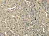 The image on the left is immunohistochemistry of paraffin-embedded Human breast cancer tissue using CSB-PA172809 (TRIB2 Antibody) at dilution 1/30, on the right is treated with fusion protein. (Original magnification: ×200)