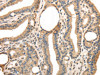 The image on the left is immunohistochemistry of paraffin-embedded Human thyroid cancer tissue using CSB-PA592034 (TRIB3 Antibody) at dilution 1/40, on the right is treated with fusion protein. (Original magnification: ×200)