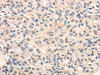 The image on the left is immunohistochemistry of paraffin-embedded Human breast cancer tissue using CSB-PA592034 (TRIB3 Antibody) at dilution 1/40, on the right is treated with fusion protein. (Original magnification: ×200)
