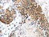 The image on the left is immunohistochemistry of paraffin-embedded Human esophagus cancer tissue using CSB-PA178293 (TRIM74 Antibody) at dilution 1/45, on the right is treated with fusion protein. (Original magnification: ×200)