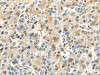 The image on the left is immunohistochemistry of paraffin-embedded Human liver cancer tissue using CSB-PA253236 (TRAIP Antibody) at dilution 1/40, on the right is treated with fusion protein. (Original magnification: ×200)