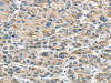 The image on the left is immunohistochemistry of paraffin-embedded Human liver cancer tissue using CSB-PA697715 (TRAIP Antibody) at dilution 1/40, on the right is treated with fusion protein. (Original magnification: ×200)