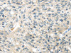 The image on the left is immunohistochemistry of paraffin-embedded Human breast cancer tissue using CSB-PA697715 (TRAIP Antibody) at dilution 1/40, on the right is treated with fusion protein. (Original magnification: ×200)