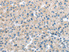 The image on the left is immunohistochemistry of paraffin-embedded Human liver cancer tissue using CSB-PA274847 (ITPA Antibody) at dilution 1/25, on the right is treated with fusion protein. (Original magnification: ×200)