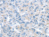 The image on the left is immunohistochemistry of paraffin-embedded Human liver cancer tissue using CSB-PA910876 (ITPA Antibody) at dilution 1/30, on the right is treated with fusion protein. (Original magnification: ×200)