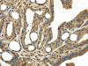 The image on the left is immunohistochemistry of paraffin-embedded Human thyroid cancer tissue using CSB-PA247380 (KEAP1 Antibody) at dilution 1/20, on the right is treated with fusion protein. (Original magnification: ×200)