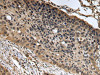 The image on the left is immunohistochemistry of paraffin-embedded Human esophagus cancer tissue using CSB-PA011976 (KEAP1 Antibody) at dilution 1/20, on the right is treated with fusion protein. (Original magnification: ×200)