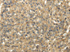 The image on the left is immunohistochemistry of paraffin-embedded Human breast cancer tissue using CSB-PA830561 (TACSTD2 Antibody) at dilution 1/35, on the right is treated with fusion protein. (Original magnification: ×200)