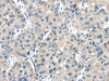 The image on the left is immunohistochemistry of paraffin-embedded Human liver cancer tissue using CSB-PA113579 (TRPM2 Antibody) at dilution 1/25, on the right is treated with fusion protein. (Original magnification: ×200)