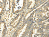 The image on the left is immunohistochemistry of paraffin-embedded Human esophagus cancer tissue using CSB-PA067976 (TUBA1C Antibody) at dilution 1/25, on the right is treated with fusion protein. (Original magnification: ×200)