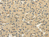 The image on the left is immunohistochemistry of paraffin-embedded Human liver cancer tissue using CSB-PA929692 (TULP2 Antibody) at dilution 1/20, on the right is treated with fusion protein. (Original magnification: ×200) The image on the left is immunohistochemistry of paraffin-embedded Human liver cancer tissue using CSB-PA929692 (TULP2 Antibody) at dilution 1/20, on the right is treated with fusion protein. (Original magnification: ×200)