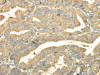 The image on the left is immunohistochemistry of paraffin-embedded Human esophagus cancer tissue using CSB-PA929692 (TULP2 Antibody) at dilution 1/20, on the right is treated with fusion protein. (Original magnification: ×200) The image on the left is immunohistochemistry of paraffin-embedded Human esophagus cancer tissue using CSB-PA929692 (TULP2 Antibody) at dilution 1/20, on the right is treated with fusion protein. (Original magnification: ×200)