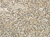 The image on the left is immunohistochemistry of paraffin-embedded Human prostate cancer tissue using CSB-PA159160 (TULP2 Antibody) at dilution 1/30, on the right is treated with fusion protein. (Original magnification: ×200)