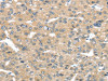 The image on the left is immunohistochemistry of paraffin-embedded Human liver cancer tissue using CSB-PA946559 (TUSC2 Antibody) at dilution 1/50, on the right is treated with fusion protein. (Original magnification: ×200)