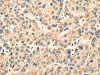 The image on the left is immunohistochemistry of paraffin-embedded Human liver cancer tissue using CSB-PA083735 (TWIST2 Antibody) at dilution 1/35, on the right is treated with fusion protein. (Original magnification: ×200)