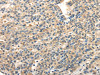 The image on the left is immunohistochemistry of paraffin-embedded Human liver cancer tissue using CSB-PA654024 (TWIST2 Antibody) at dilution 1/20, on the right is treated with fusion protein. (Original magnification: ×200)