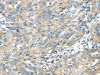 The image on the left is immunohistochemistry of paraffin-embedded Human breast cancer tissue using CSB-PA160058 (TXNDC5 Antibody) at dilution 1/40, on the right is treated with fusion protein. (Original magnification: ×200)