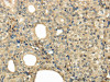 The image on the left is immunohistochemistry of paraffin-embedded Human thyroid cancer tissue using CSB-PA170670 (UBE2B Antibody) at dilution 1/30, on the right is treated with fusion protein. (Original magnification: ×200)