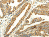 The image on the left is immunohistochemistry of paraffin-embedded Human esophagus cancer tissue using CSB-PA560918 (UBL4B Antibody) at dilution 1/25, on the right is treated with fusion protein. (Original magnification: ×200)