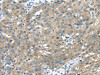 The image on the left is immunohistochemistry of paraffin-embedded Human breast cancer tissue using CSB-PA257638 (UCHL3 Antibody) at dilution 1/35, on the right is treated with fusion protein. (Original magnification: ×200)