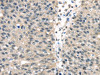 The image on the left is immunohistochemistry of paraffin-embedded Human breast cancer tissue using CSB-PA998471 (UCHL3 Antibody) at dilution 1/25, on the right is treated with fusion protein. (Original magnification: ×200)