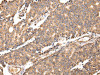 The image on the left is immunohistochemistry of paraffin-embedded Human prostate cancer tissue using CSB-PA968491 (UGGT2 Antibody) at dilution 1/20, on the right is treated with fusion protein. (Original magnification: ×200)