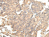 The image on the left is immunohistochemistry of paraffin-embedded Human prostate cancer tissue using CSB-PA051537 (UGGT2 Antibody) at dilution 1/25, on the right is treated with fusion protein. (Original magnification: ×200)