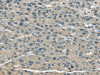 The image on the left is immunohistochemistry of paraffin-embedded Human liver cancer tissue using CSB-PA995817 (UGP2 Antibody) at dilution 1/25, on the right is treated with fusion protein. (Original magnification: ×200)