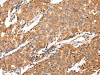 The image on the left is immunohistochemistry of paraffin-embedded Human prostate cancer tissue using CSB-PA901991 (MAP2 Antibody) at dilution 1/20, on the right is treated with fusion protein. (Original magnification: ×200)