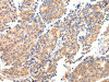 The image on the left is immunohistochemistry of paraffin-embedded Human prostate cancer tissue using CSB-PA584071 (MAP2 Antibody) at dilution 1/20, on the right is treated with fusion protein. (Original magnification: ×200)