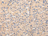 The image on the left is immunohistochemistry of paraffin-embedded Human liver cancer tissue using CSB-PA227161 (PPP5C Antibody) at dilution 1/20, on the right is treated with fusion protein. (Original magnification: ×200)
