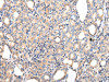 The image on the left is immunohistochemistry of paraffin-embedded Human thyroid cancer tissue using CSB-PA227161 (PPP5C Antibody) at dilution 1/20, on the right is treated with fusion protein. (Original magnification: ×200)