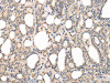 The image on the left is immunohistochemistry of paraffin-embedded Human thyroid cancer tissue using CSB-PA905112 (PPP5C Antibody) at dilution 1/20, on the right is treated with fusion protein. (Original magnification: ×200)