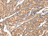 The image on the left is immunohistochemistry of paraffin-embedded Human prostate cancer tissue using CSB-PA187364 (SWAP70 Antibody) at dilution 1/20, on the right is treated with fusion protein. (Original magnification: ×200)