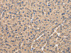 The image on the left is immunohistochemistry of paraffin-embedded Human liver cancer tissue using CSB-PA560189 (UQCRC1 Antibody) at dilution 1/35, on the right is treated with fusion protein. (Original magnification: ×200)