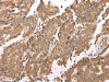 The image on the left is immunohistochemistry of paraffin-embedded Human prostate cancer tissue using CSB-PA569709 (UQCRC2 Antibody) at dilution 1/25, on the right is treated with fusion protein. (Original magnification: ×200)