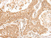 The image on the left is immunohistochemistry of paraffin-embedded Human colorectal cancer tissue using CSB-PA693911 (USP45 Antibody) at dilution 1/25, on the right is treated with fusion protein. (Original magnification: ×200)