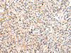 The image on the left is immunohistochemistry of paraffin-embedded Human prostate cancer tissue using CSB-PA899191 (VASH1 Antibody) at dilution 1/20, on the right is treated with fusion protein. (Original magnification: ×200)