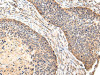The image on the left is immunohistochemistry of paraffin-embedded Human esophagus cancer tissue using CSB-PA039084 (VIL1 Antibody) at dilution 1/30, on the right is treated with fusion protein. (Original magnification: ×200)