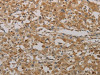 The image on the left is immunohistochemistry of paraffin-embedded Human lung cancer tissue using CSB-PA046504 (AATK Antibody) at dilution 1/25, on the right is treated with synthetic peptide. (Original magnification: ×200)