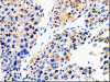 The image on the left is immunohistochemistry of paraffin-embedded Human liver cancer tissue using CSB-PA988836 (ABCG2 Antibody) at dilution 1/100, on the right is treated with synthetic peptide. (Original magnification: ×200)