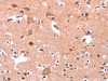 The image on the left is immunohistochemistry of paraffin-embedded Human brain tissue using CSB-PA196653 (ABI1 Antibody) at dilution 1/40, on the right is treated with synthetic peptide. (Original magnification: ×200)