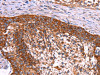 The image on the left is immunohistochemistry of paraffin-embedded Human cervical cancer tissue using CSB-PA961270 (ABI1 Antibody) at dilution 1/40, on the right is treated with synthetic peptide. (Original magnification: ×200)