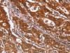 The image on the left is immunohistochemistry of paraffin-embedded Human gastric cancer tissue using CSB-PA961270 (ABI1 Antibody) at dilution 1/40, on the right is treated with synthetic peptide. (Original magnification: ×200)